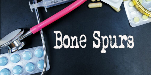 Bone Spurs &#8211; Causes, Types, and Management Options