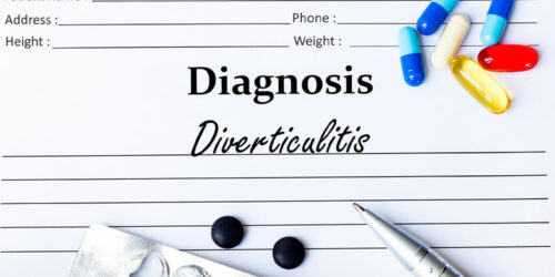 Diverticulitis &#8211; Causes, Symptoms, and How to Manage the Condition