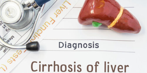 Liver Cirrhosis &#8211; Its Stages and Prevention