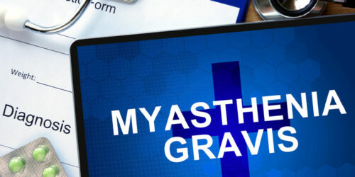 Top Therapies for Those With Myasthenia Gravis