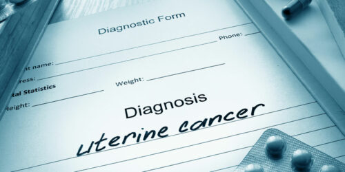 Uterine Cancer &#8211; Its Causes, Symptoms, and Stages