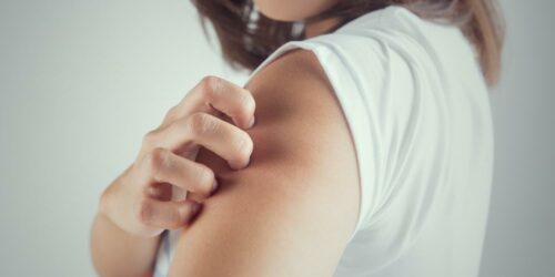 10 Reasons Why You Get Hives