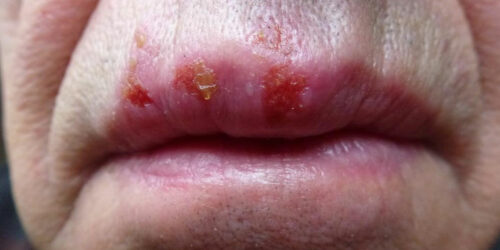 7 myths about herpes