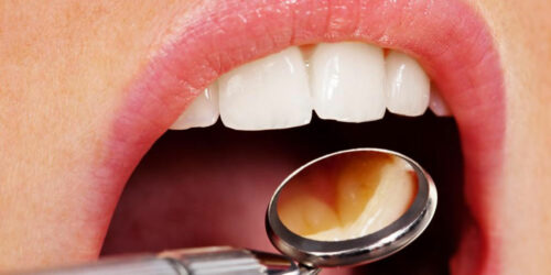 4 myths about dental implants busted