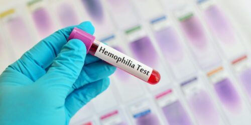 4 best foods for hemophilia