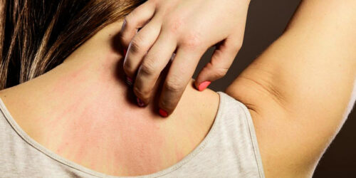 4 common causes that lead to eczema