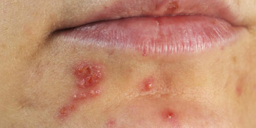 4 effective ways to treat herpes