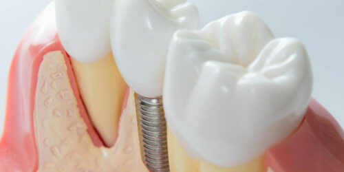 4 practical tips to maintain dental implants for seniors