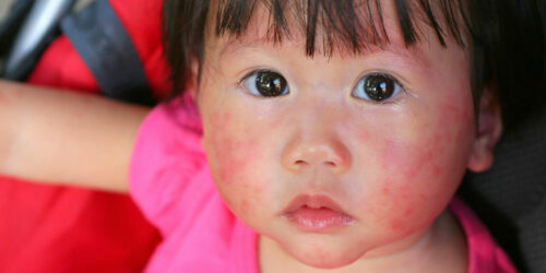 4 useful tips to treatment of atopic dermatitis in children