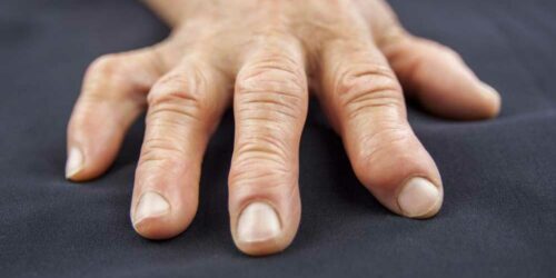 5 Causes of Swollen Fingers