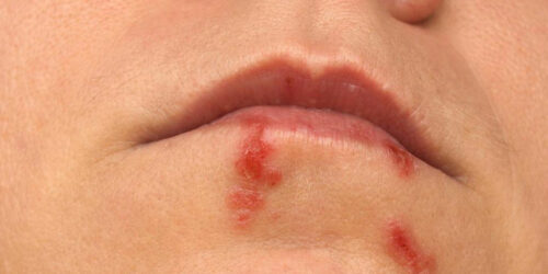 5 natural ways to deal with cold sore