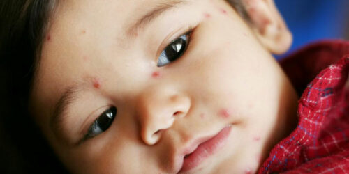 5 tell-tale signs of chickenpox you should know about