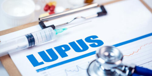 5 things to know about Lupus