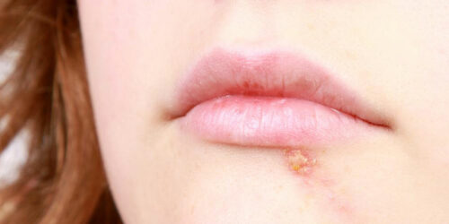 5 useful home remedies to get relief from cold sores