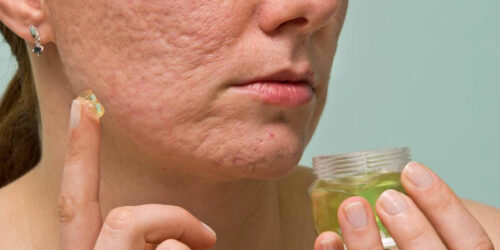 6 useful tips to treat acne scars, marks, and blemishes