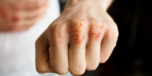 9 solutions for managing psoriasis flare-ups