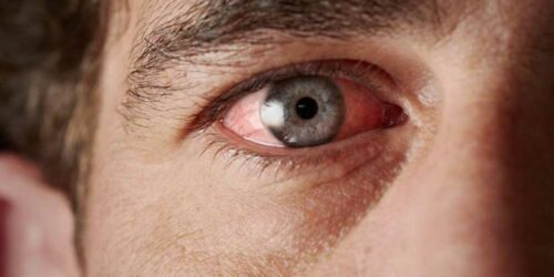 Common Causes of Blood Vessel Burst in the Eye