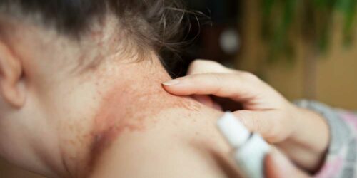 Common Signs and Symptoms of Eczema