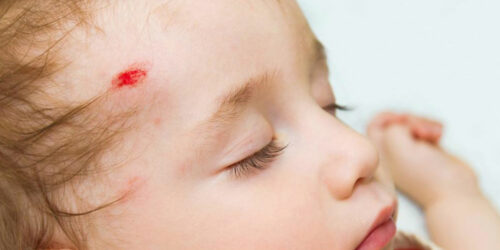 Common head injury symptoms in adults and children