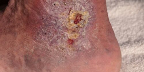 Causes and Symptoms of Cellulitis