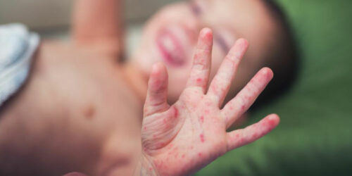 Causes and symptoms of Hand-foot-and-mouth disease