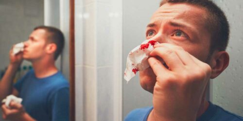 Causes of Nose Bleeding and How to Cure It