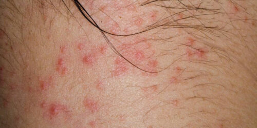 Curious about atopic dermatitis? Here’s what you need to know