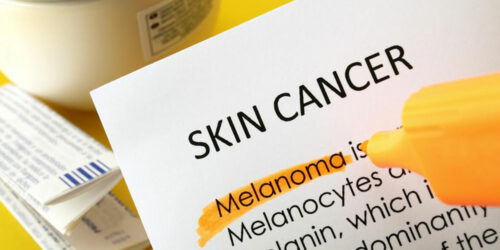 An overview of skin cancer