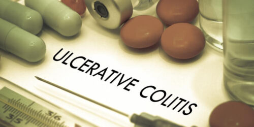 An overview for the treatment of Ulcerative Colitis