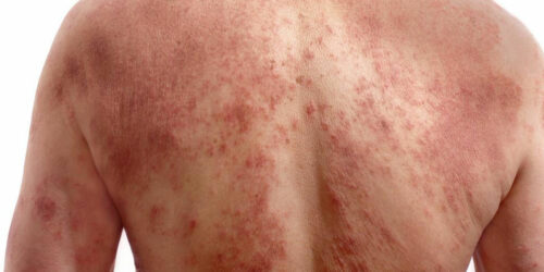 A few quick ways to identify chickenpox infection