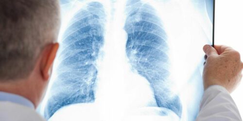 A few things you should know about mesothelioma cancer