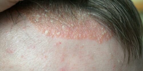 All you need to know about scalp psoriasis