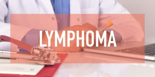 Best Treatment Options for Non Hodgkin Lymphoma