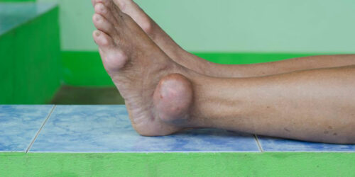 Gout attacks and their treatment procedures