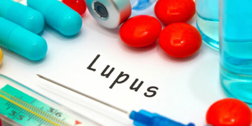 General Procedures Involved in Lupus Management