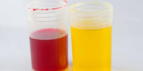 Definition, causes and symptoms of urine color