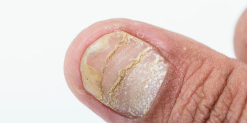 Different types of nail diseases and their causes