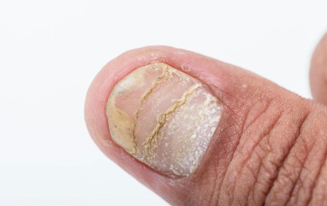 Different types of nail diseases and their causes