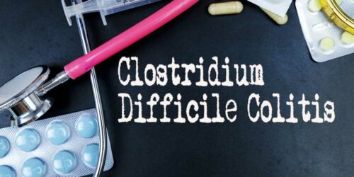 Early Symptoms of Clostridium Difficile Colitis