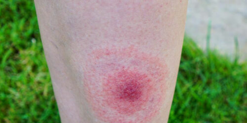 Early signs of lyme disease