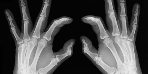 Early signs of rheumatoid arthritis and how to catch them