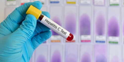 Early signs and symptoms of Hepatitis C