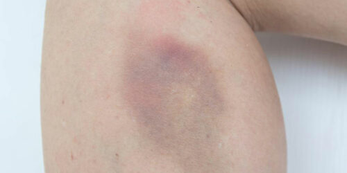 Easy bruising &#8211; Causes and treatments