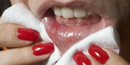 Effective ways to prevent cold sores