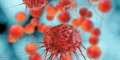 Everything you need to know about metastatic ovarian cancer