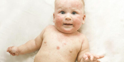 Everything you need to know about atopic dermatitis