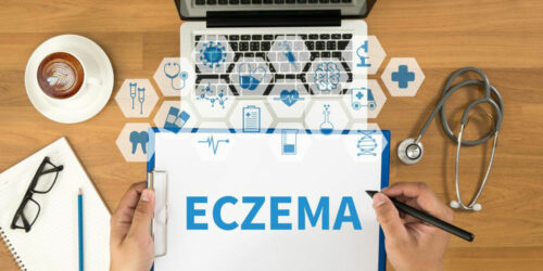 Everything you need to know about eczema