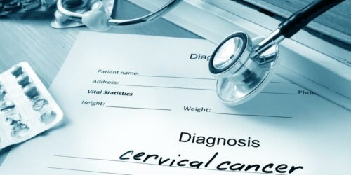 Everything you need to know about the diagnosis and staging of cervical cancer