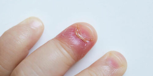 Four reasons for swollen finger pain