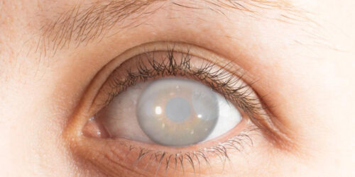 Five facts to know about cataract and its surgery